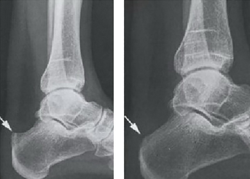 Болезнь Хаглунда | Фото до и после, операция, отзывы, лечение, реабилитация и восстановление