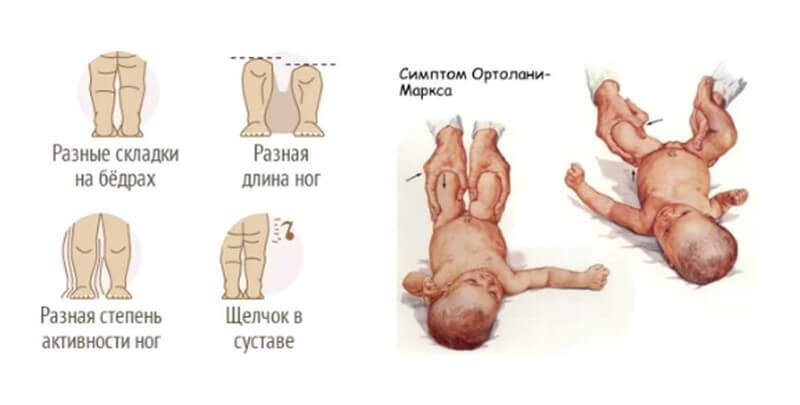 Признаки дисплазии тазобедренных суставов у новорожденных