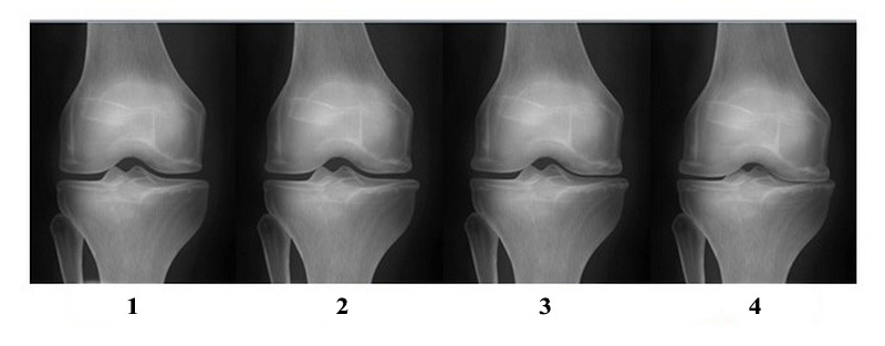 Деформирующий артроз коленного сустава 1, 2 степени лечение - 