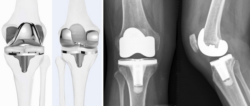 Рентген коленного сустава – Рентгенография – диагностическое отделение в МЦОЗ