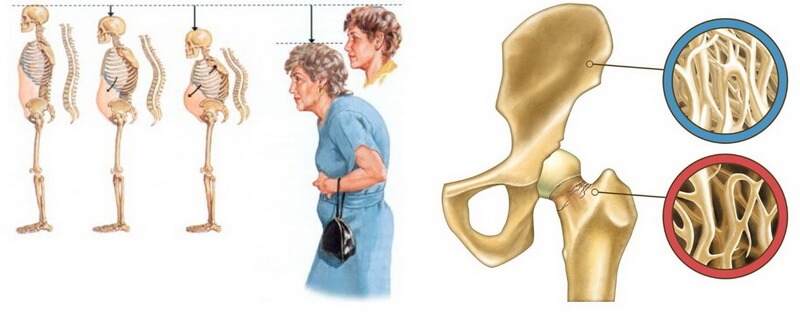 Основные симптомы остеопороза