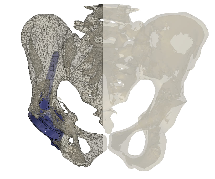 Индивидуальная 3D-модель эндопротеза тазобедренного сустава