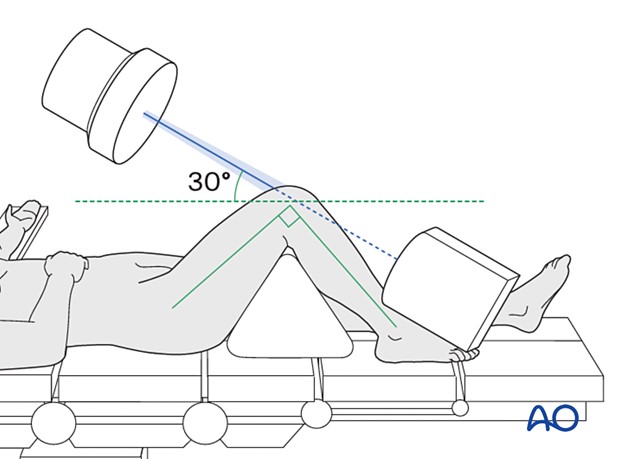 Інтраопераційна візуалізація наколінка (наколі́нок, надколінок, надколінник (лат. patella, колінна чашечка)