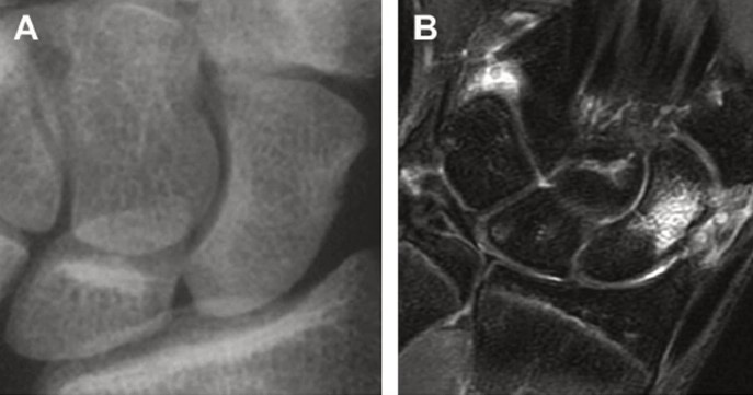 Слева – рентгенография без признаков перелома, справа – МРТ с признаками отека кости в месте травмы