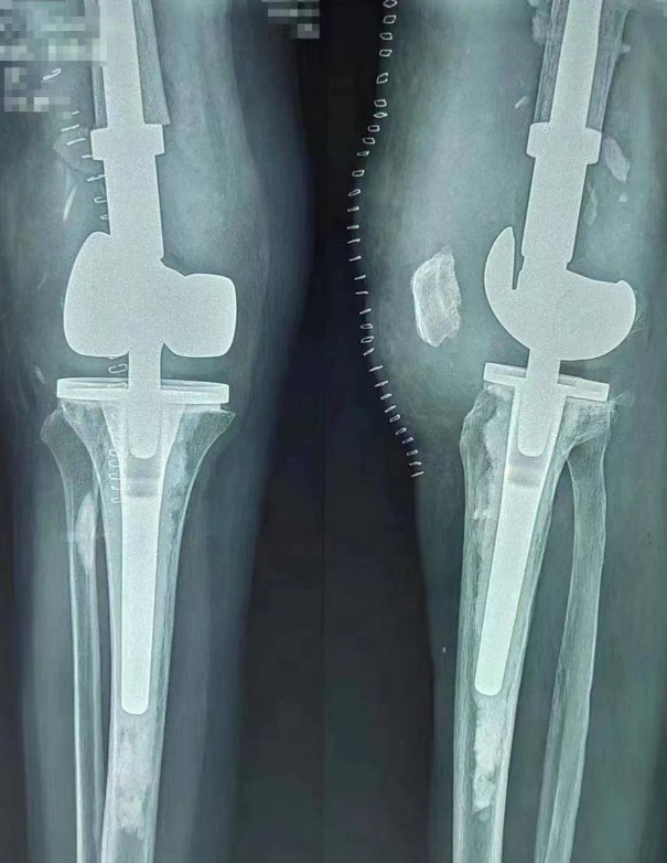 Реверсивный протез коленного сустава от Chunli Medical