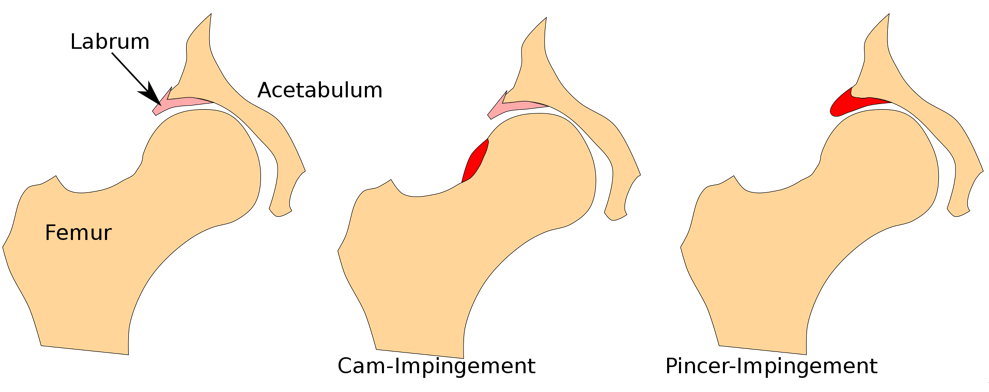 Импиджмент-синдром в тазобедренном суставе (Феморо-ацетабулярный импинджмент - ФАИ, синдром бедренно-вертлужного соударения, феморо-ацетабулярный конфликт)
