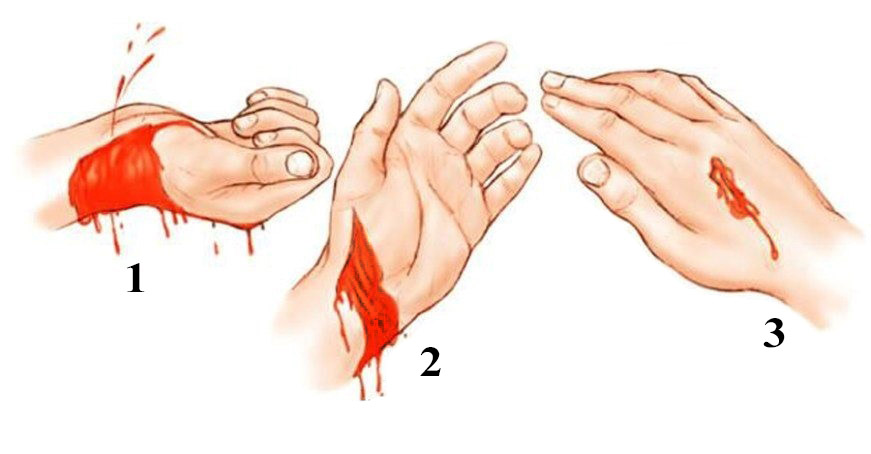 1. Артериальное кровотечение – характеризуется наличием пульсирующей струи ярко алой крови из поврежденного сосуда. 2. Венозное – кровь темная, может вытекать медленно, но с постоянным давлением. 3. Капиллярное - основной признак поврежденных капилляров - проступившая кровь ярко-красного цвета по всей раневой поверхности. Смешанное – когда в результате массированной травмы повреждены вены, артерии и капилляры.