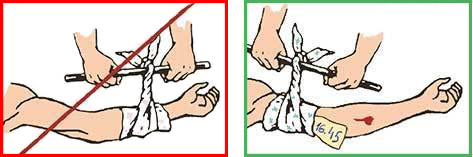 Правила наложение жгутовой повязки при артериальном кровотечении 