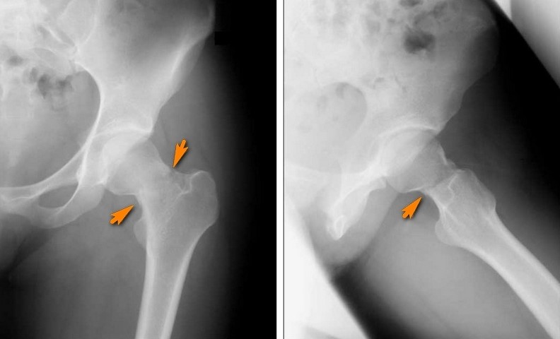 Стресс-перелом шейки бедренной кости (Усталостные переломы, перелом напряжения, insufficiency fractures)