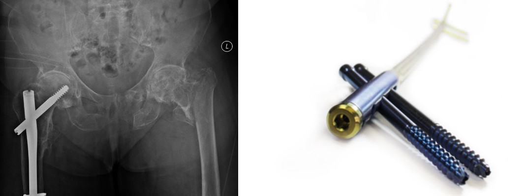 Имплантаты от фирмы ChM для лечения полного стресс-перелома шейки бедренной кости