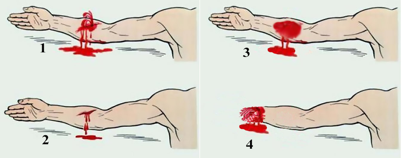 1. Артериальное кровотечение 2. Венозное кровотечение 3. Капиллярное кровотечение 4. Травматическая ампутация