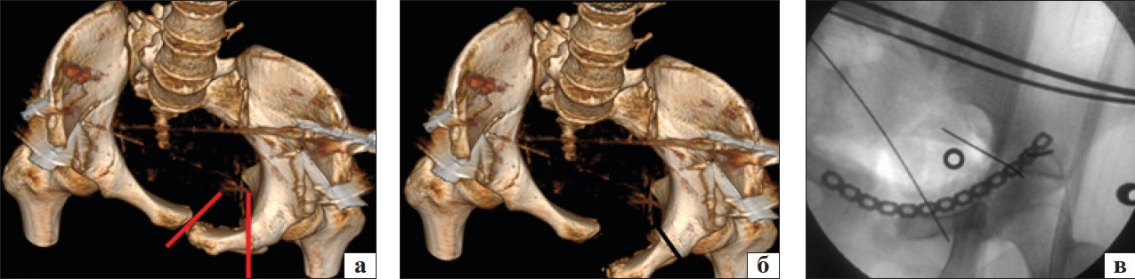 Рис. 4. 3D-планування пересічення симфізу та остеотомії лобкової кістки (червоні лінії) по місцю неправильного зрощення (а), репозиції лобкової кістки в анатомічне положення (б) та зображення її під ЕОП (в); 3D-планування (г) та зображення під ЕОП (д) репозиції лобкової кістки в анатомічне положення та остаточної фіксації пластиною та гвинтами (жовті лінії)