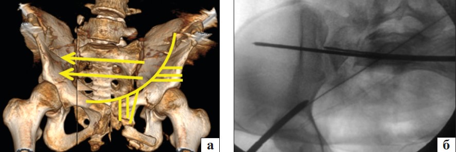 Рис. 7. 3D-планування (а) та зображення під ЕОП (б) проведення спиць (жовті стрілки) на рівні SI‒SII  через зону остеотомії