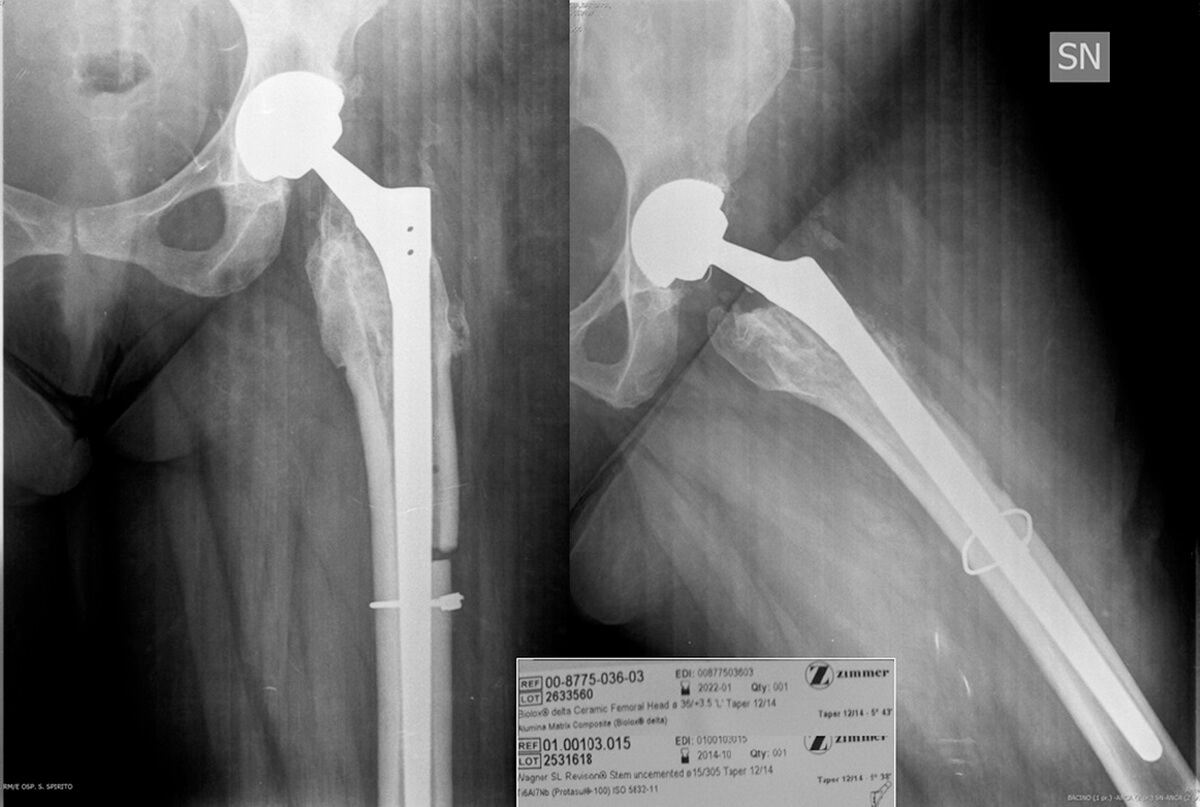 Modular titanium alloy neck failure in total hip replacement: analysis of a relapse case 