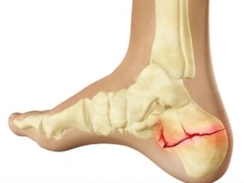 Основной причиной переломов пяточной кости является падение с высоты, в других случаях переломы возникают вследствие прямого удара или сжатия.