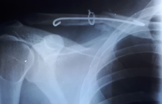 Відсутність рентгенологічної динаміки впродовж 18 місяців – формування хибного суглоба правої ключиці