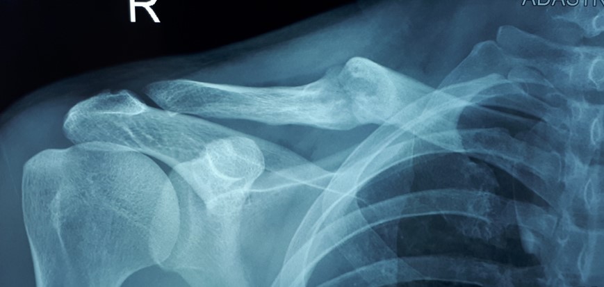 Отсутствие рентгенологической динамики в течение 18 месяцев – формирование ложного сустава правой ключицы