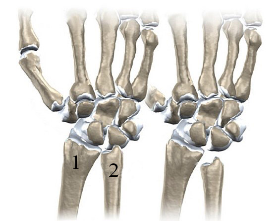 Слева - нормальная длина лучевой и локтевой костей, справа - врожденная короткая локтевая кость