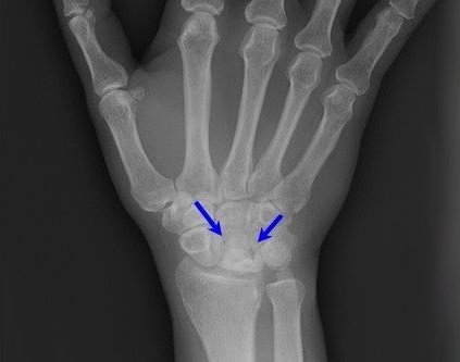 Рентгенограмма при болезни Кинбека.