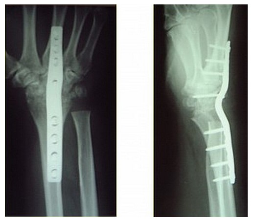 Рентгенограмма после артродеза кистевого сустава по поводу 4 стадии болезни Кинбека