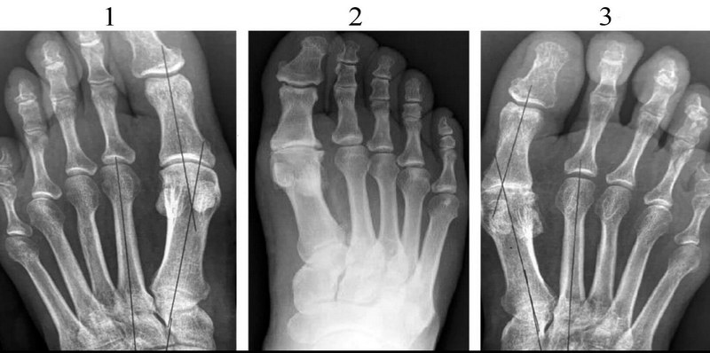 Hallux Rigidus (тугоподвижность первого плюснефалангового сустава большого пальца стопы, hallux limitus, деформирующий остеоартроз) Причины, симптомы, диагностика, лечение и реабилитация, профилактика и прогноз