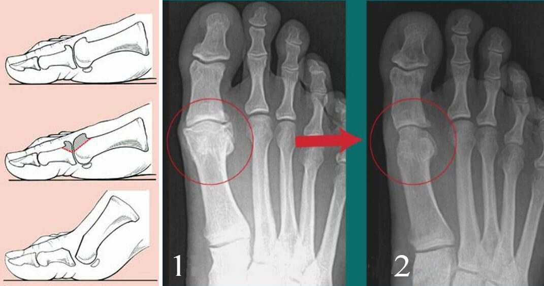 Hallux Rigidus (тугоподвижность первого плюснефалангового сустава большого пальца стопы, hallux limitus, деформирующий остеоартроз) Причины, симптомы, диагностика, лечение и реабилитация, профилактика и прогноз