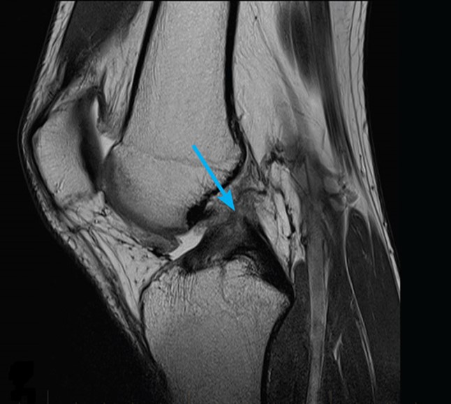 На снимке – разрыв крестообразной связки и мениска вследствие травмы колена