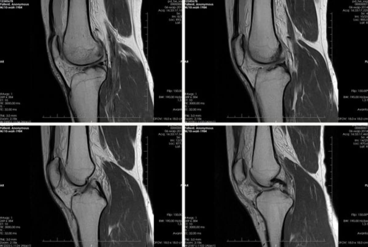 Пример МРТ коленного сустава