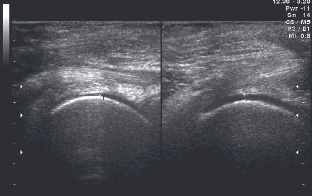 Рис. 3. Неравномерное понижение толщины гиалинового хряща правого коленного сустава при поперечном сканировании с заднего доступа