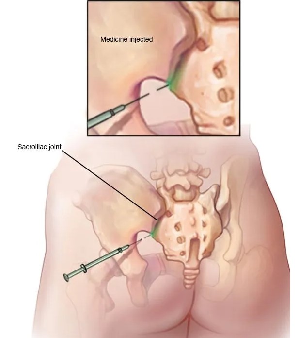 Внутрисуставные инъекции. Суть данной процедуры заключается в том, что лекарственные препараты вводятся непосредственно в область сустава под УЗИ-контролем, что позволяет достичь максимально точного воздействия на сустав.
