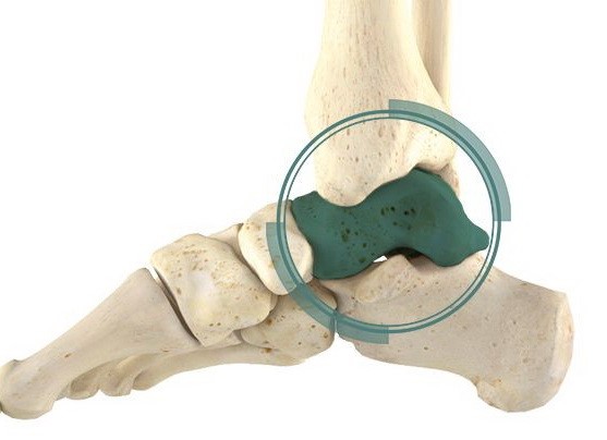 Комплексное лечение асептического остеонекроза таранной кости или «стволовые клетки в ортопедии-травматологии 2.0»