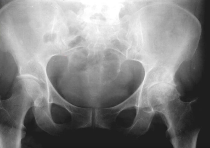 Сужение суставной щели, остеофиты, остеосклероз