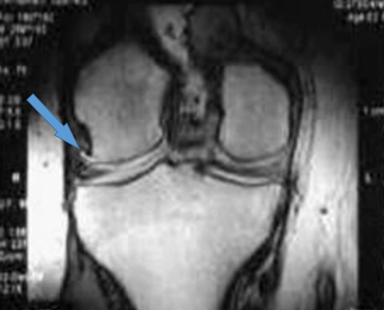 Суставная щель сохранена, но неравномерна с медиальной и латеральной стороны. Четко визуализируется остеофит