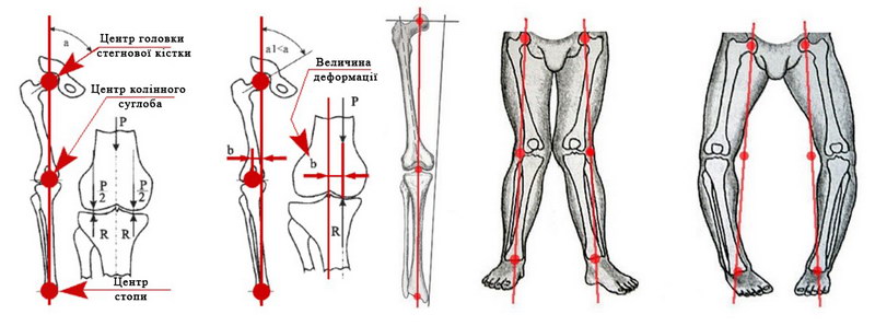Расчет деформации оси нижних конечностей (схематически)