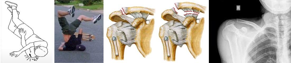 Основной механызм травмы – прямой, падение на наружную поверхность плеча или вытянутую руку при занятии спортом или активных видах отдыха. Летом это скейтборды, велосипеды, ролики, скутеры или самокаты. Зимой – лыжи, коньки.