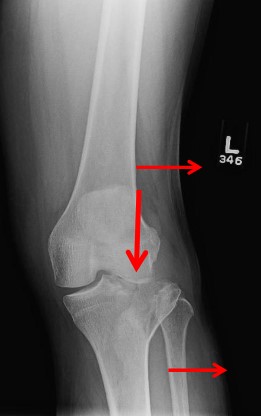Переломи проксимального відділу гомілки. Сучасний підхід у діагностиці та лікуванні.