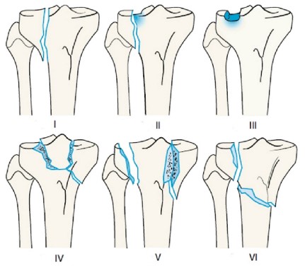 Класифікація за Schatzker. Type I: Split fracture of the lateral plateau, Type II: Split depression fracture of the lateral plateau, Type III: Pure depression fracture of the lateral plateau, Type IV: Medial plateau (possible fracture / dislocation), Type V: Bicondylar plateau fracture, Type VI: Plateau fracture with metaphyseal / diaphyseal dissociation
