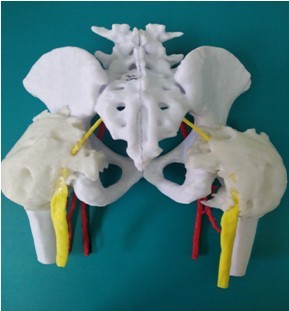 Пластиковый макет-прототип костей таза с «замурованными» в гетеротопических оссификатах седалищных нервах. 