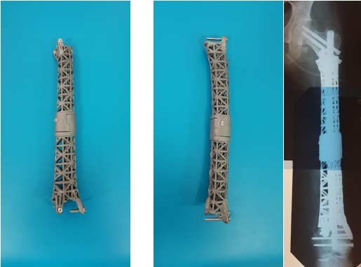 Индивидуальный титановый 3D-печатный эндопротез диафиза левой бедренной кости, спроектированный в лаборатории биомедицинской инженерии и результат оперативного вмешательства, выполненного в ИТО НАМНУ.