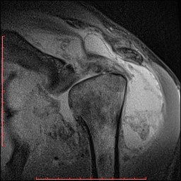 Идиопатическая сирингомиелия, патологический перелом лопатки, остеоартропатия левого плечевого сустава