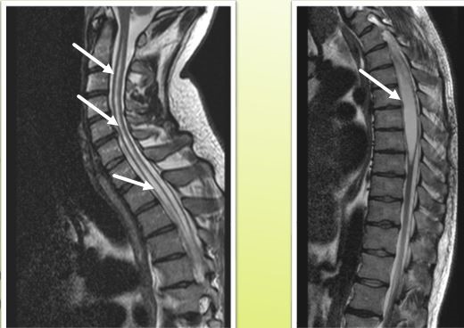 Идиопатическая сирингомиелия, патологический перелом лопатки, остеоартропатия левого плечевого сустава